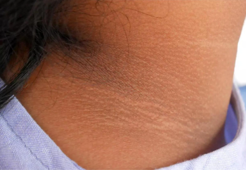 Béo phì ảnh hưởng như thế nào tới da và các bệnh về da